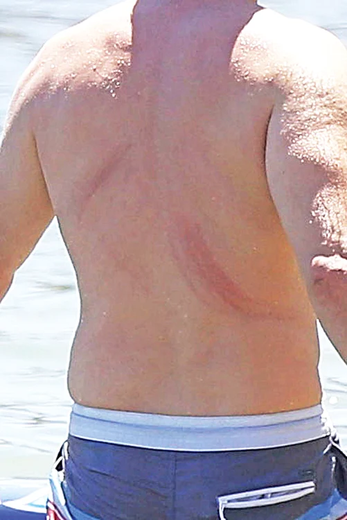 Uite ce zgârieturi  i-a lăsat iubita  pe spate