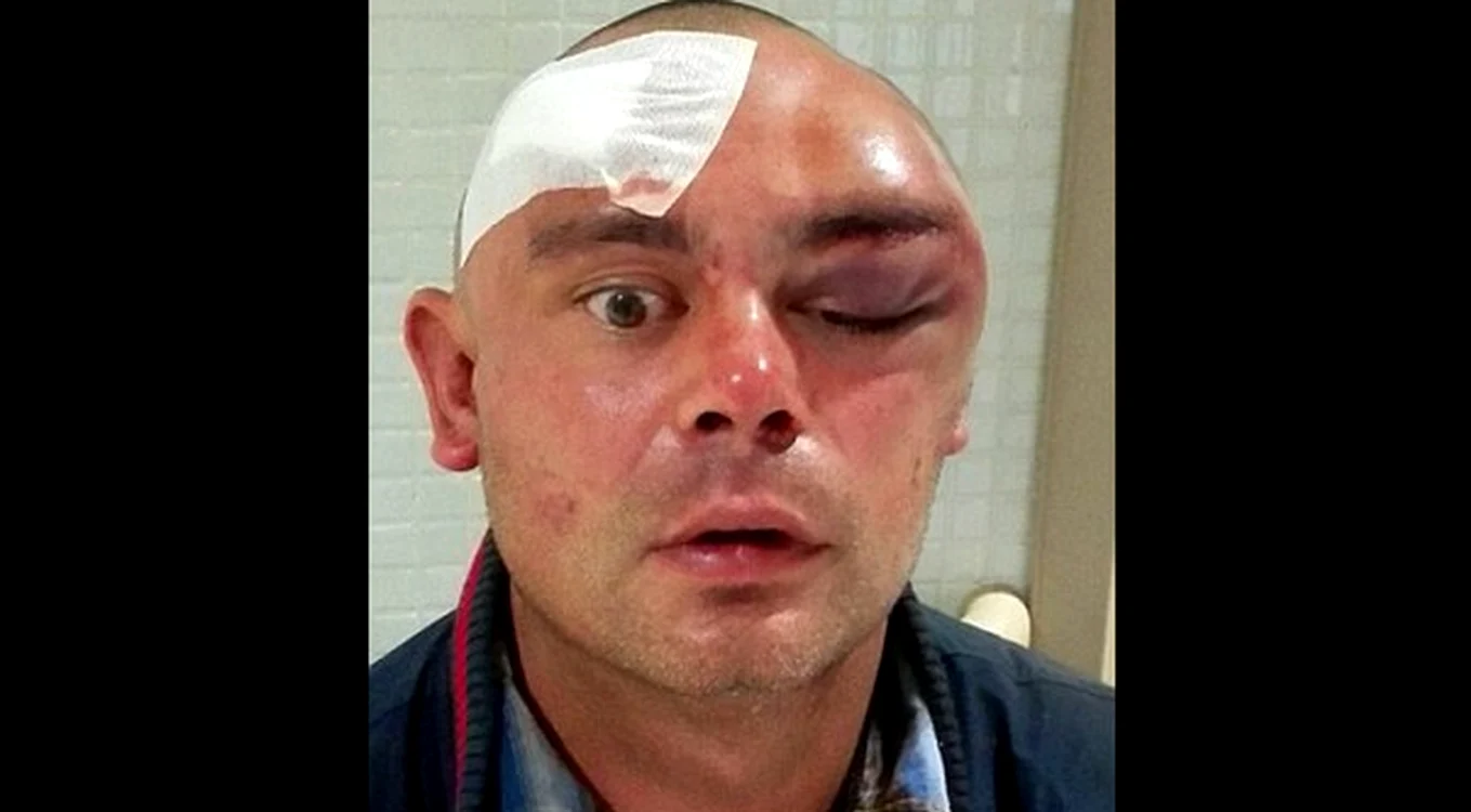 
    Englezul a suferit răni serioase și a avut nevoie de copci, în zona fețeiFoto: mirror.co.uk  
