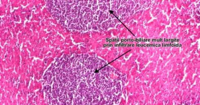 Braşov: Laboratoare la Codlea şi Bucureşti pentru leucemia mieloidă cronică