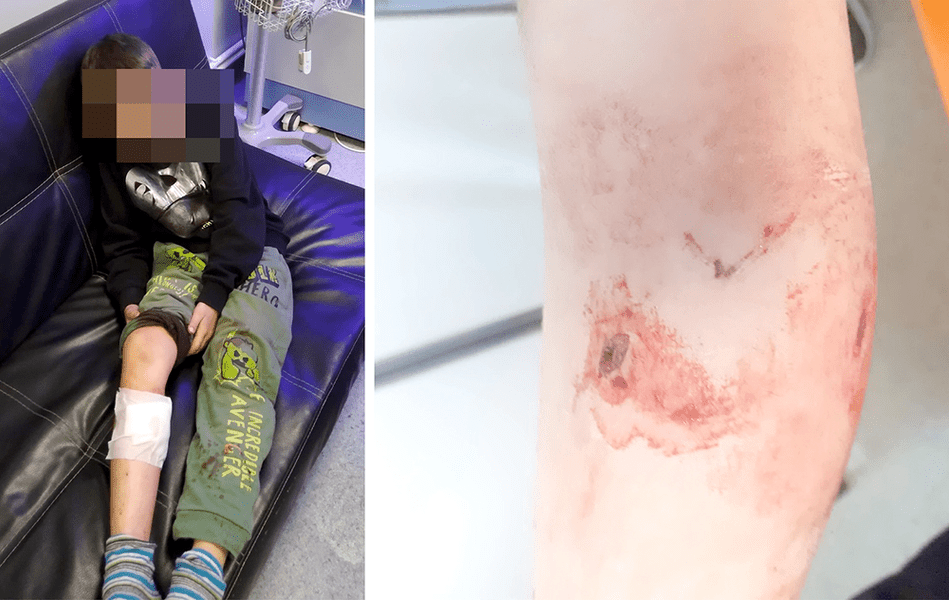 Copil sfâșiat de un câine într-un parc din Vaslui. Băiețelul a ajuns în stare gravă la spital