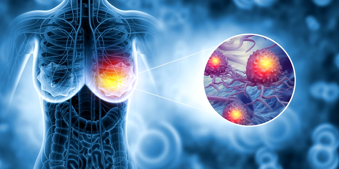 Cancerul de sân, o boală tratabilă dacă este descoperită în primele stadii FOTO: Shutterstock