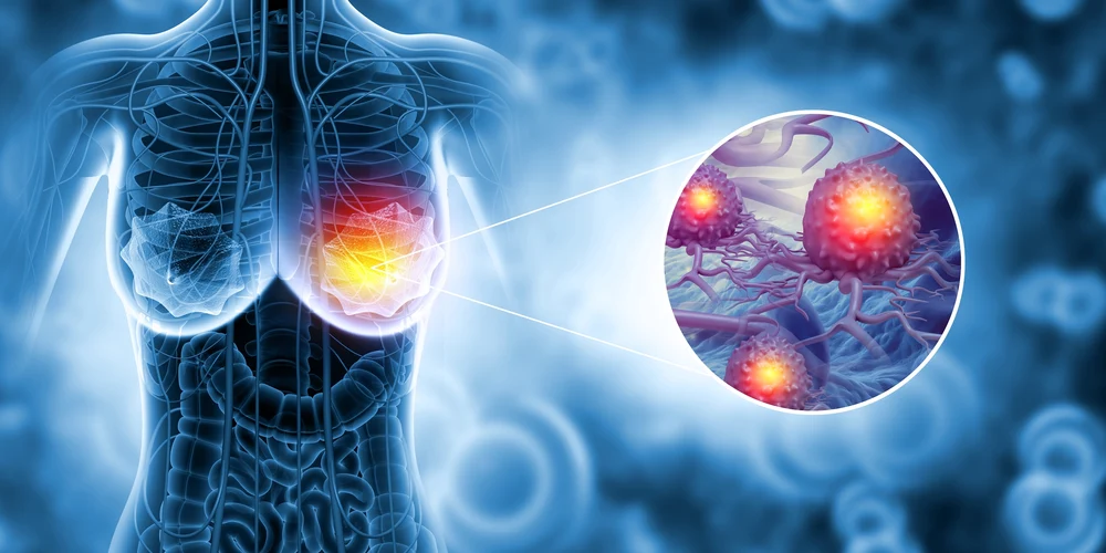 Medic senolog, despre cât de mult contează prevenția și genetica în cancerul la sân. „Mamografia: două minute care pot salva o viață“