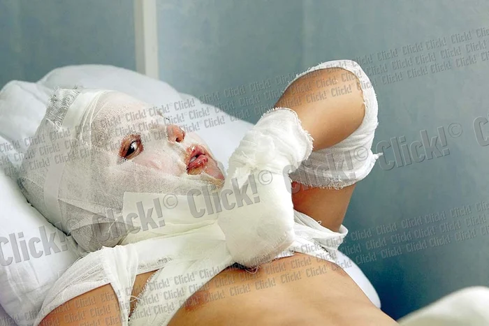 David a suferit arsuri pe faţă şi pe piept (Fotografii: Dorin Constanda)