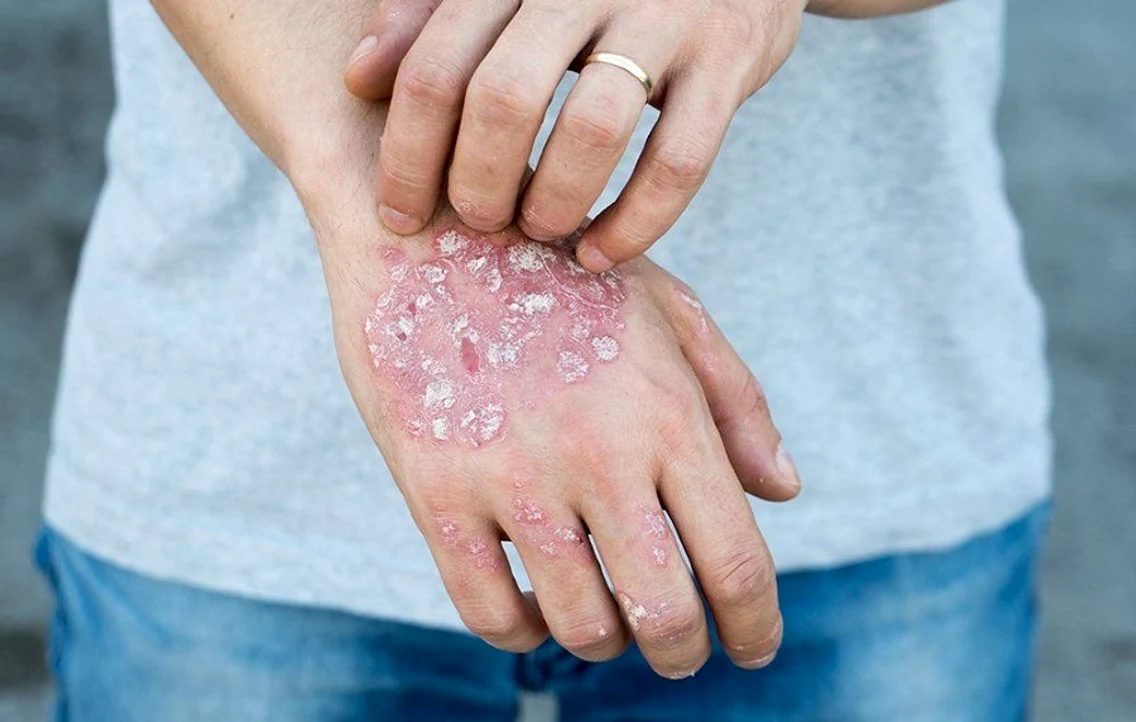 2 psoriazis 3 jpg jpeg