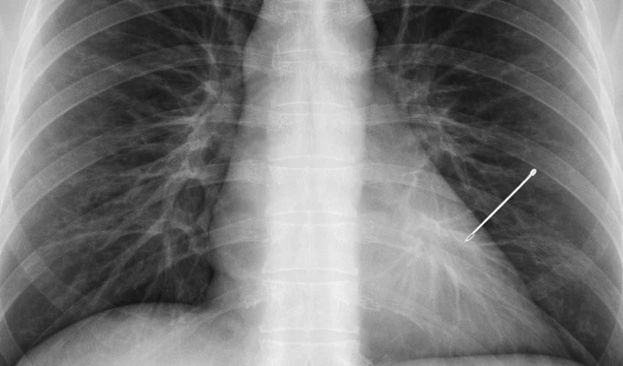 Ac găsit în plămân Foto: FB