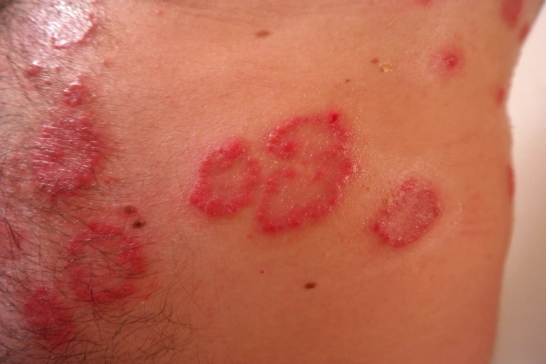 
    Cercetătorii au descoperit mai multe simptome dermatologice care apar la bolnavii de Covid-19Foto: Pixabay  