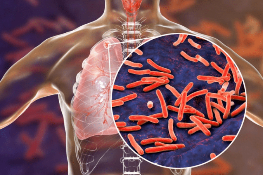 Depistarea tuberculozei, o urgență de sănătate publică