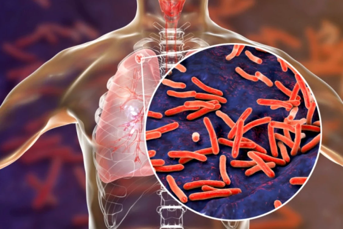 Tuberculoza, care afectează cel mai frecvent plămânii, este o boală infecţioasă cauzată de bacteria Mycobacterium tuberculosis Foto: doc.ro