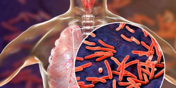 Tuberculoza foto doc.ro