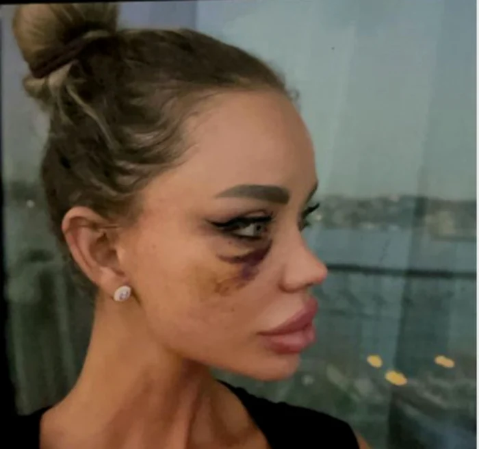 Bianca Drăguşanu, victimă a violenţei domestice