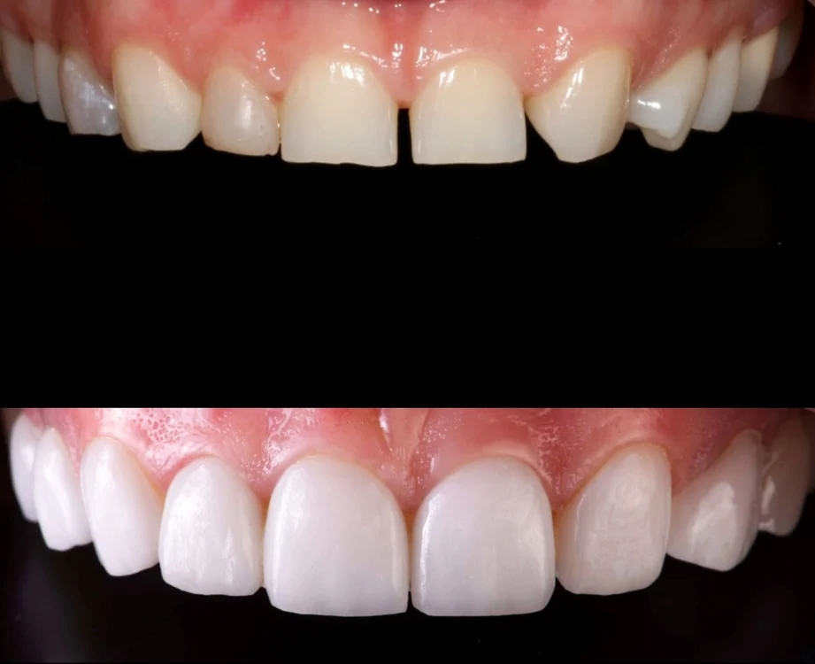 Impactul fațetelor dentare: mai mult decât estetică!