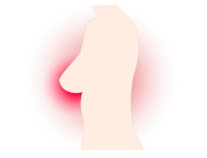 Cancer mamar / foto: Pixabay