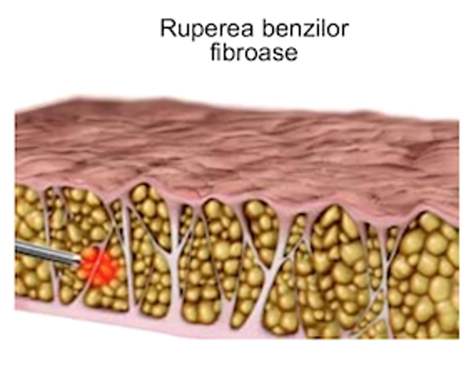 Secţionând benzile fibroase, eliberezi pielea de tensiune