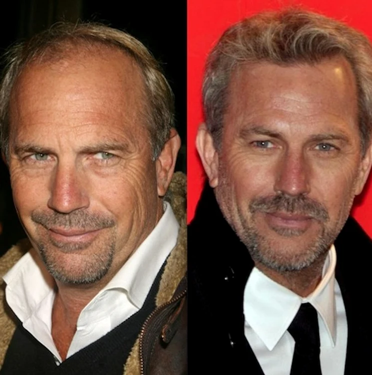 Deși nu a recunoscut niciodată, rezultatul unei astfel de intervenții este vizibil în cazul actorului Kevin Costner.foto: Facebook