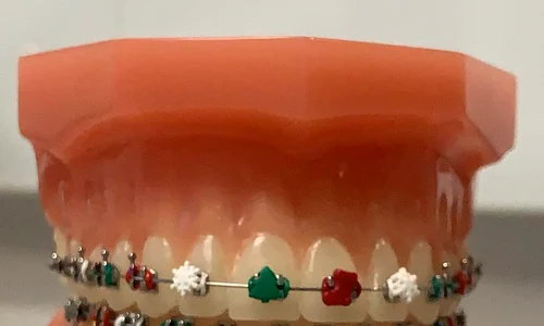 Aparatele dentare cu brăduți sau fulgi de nea, ultima modă în rândul adolescenților jpeg