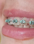 aparat dentar jpg