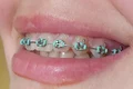 aparat dentar jpg