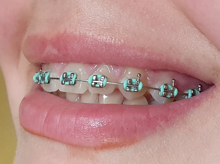 Ce este indicat să mănânci și ce să eviți atunci când porți aparat dentar.