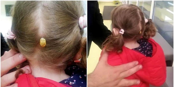 capusa fetita scalp suceava 