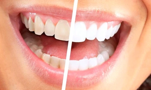 1 truc bio pentru albirea dintilor jvgt jpg jpeg