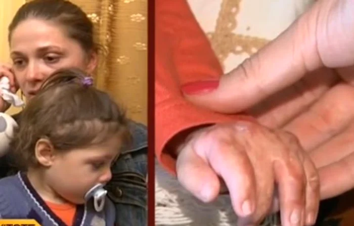 Alexandru este plin de cicatrici şi şi-a pierdut mobilitatea la o mână (foto:Kanal D)