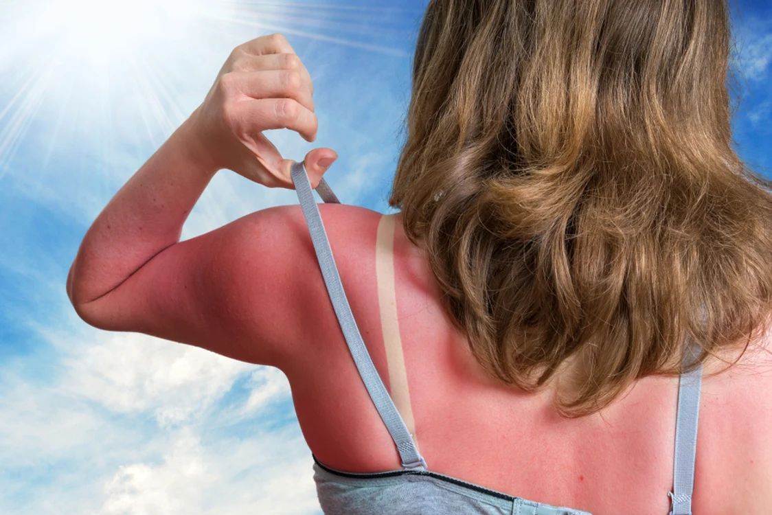 Arsura solară, printre cele mai comune probleme în vacanță. FOTO: Unsplash