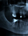 radiografie dentara shutterstock 2313970569 jpg