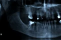 radiografie dentara shutterstock 2313970569 jpg