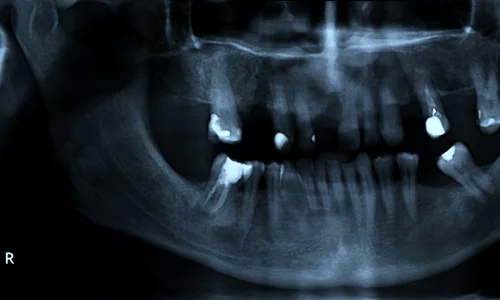 radiografie dentara shutterstock 2313970569 jpg
