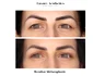 rezultat blefaroplastie iancu morad luxury aesthetics 1 jpg