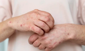 scabie raie mancarime piele freepik jpg