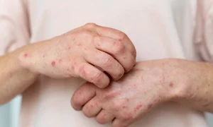 scabie raie mancarime piele freepik jpg