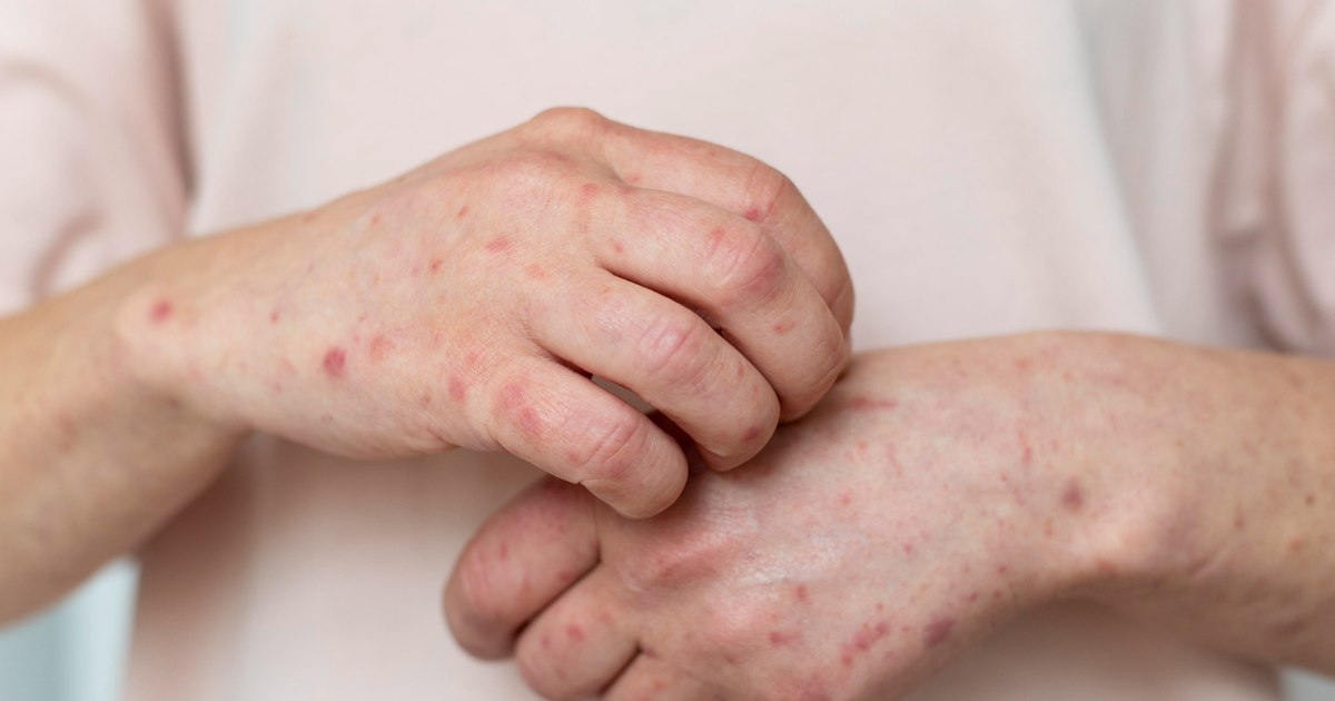 Focar de scabie la Spitalul de Psihiatrie Jebel: sursa va fi identificată de DSP. Focar de scabie la Spitalul de Psihiatrie Jebel: sursa va fi identificată de DSP.