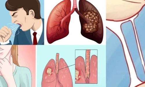 1 cancer pulmonar 700x335 jpg jpeg