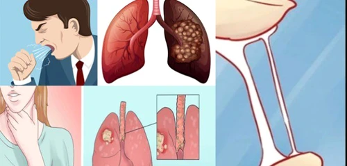 1 cancer pulmonar 700x335 jpg jpeg