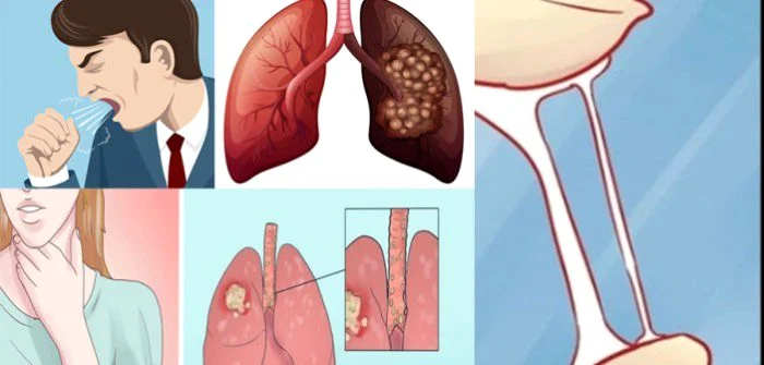 1 cancer pulmonar 700x335 jpg jpeg