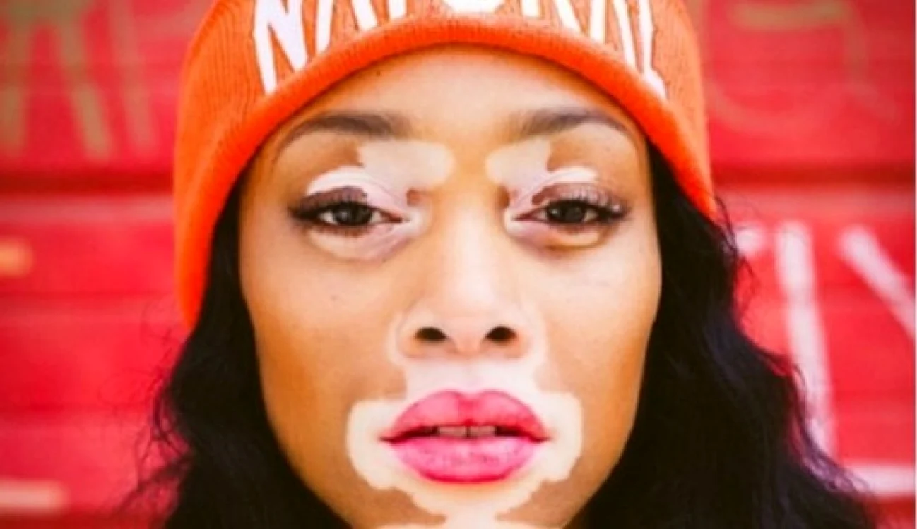vitiligo