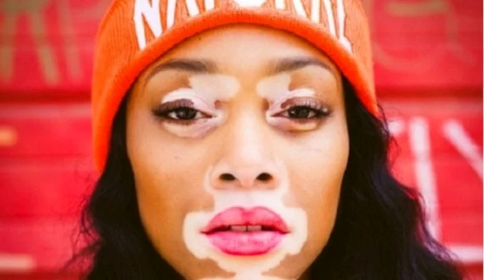 vitiligo