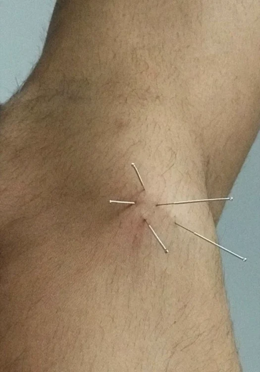 Remus Boroiu se tratează cu acupunctură
