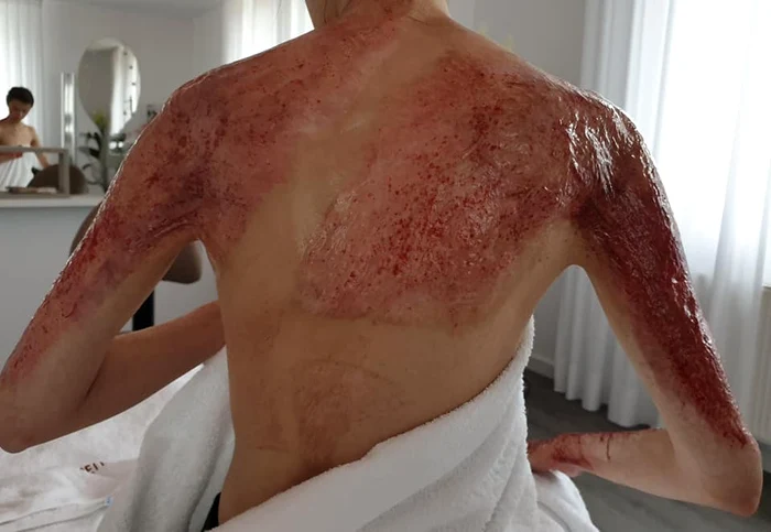 Alexandra Furnea a suferit mai multe operaţii de reconstrucţie