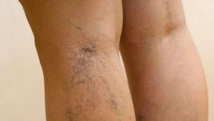 Varicele se pot trata cu o singură injecţie, într-o şedinţă