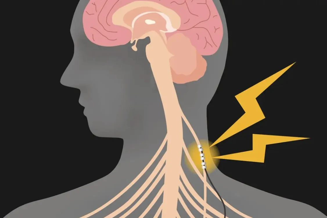 Dispozitivul acționează asupra nervului vag FOTO: Healthy women webp