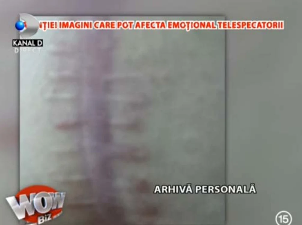Oana Roman a fost tăiată de sus până jos pe burtă