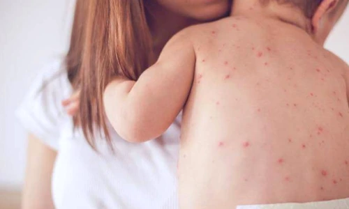 1 simptome pojar sau varsat de vant jpg jpeg