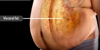 Grasime viscerală vs grasime subcutanată Foto WebMDms jpg