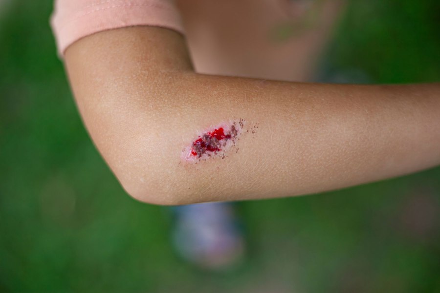 Boala infecțioasă gravă, cu mortalitate ridicată dacă nu este tratată rapid și corect. Sporii care o cauzează pot supraviețui ani de zile