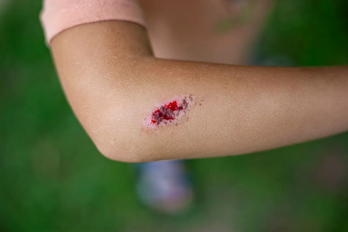 Rănile nu pot fi considerate banale când există riscul de contaminare cu spori FOTo. Shutterstock