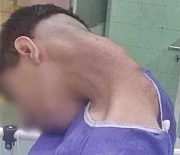 Sindromul capului căzut FOTO: captura video