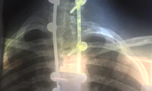 1 radiografie scolioza jpg jpeg