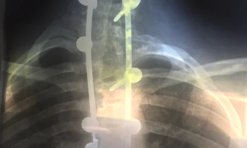 1 radiografie scolioza jpg jpeg